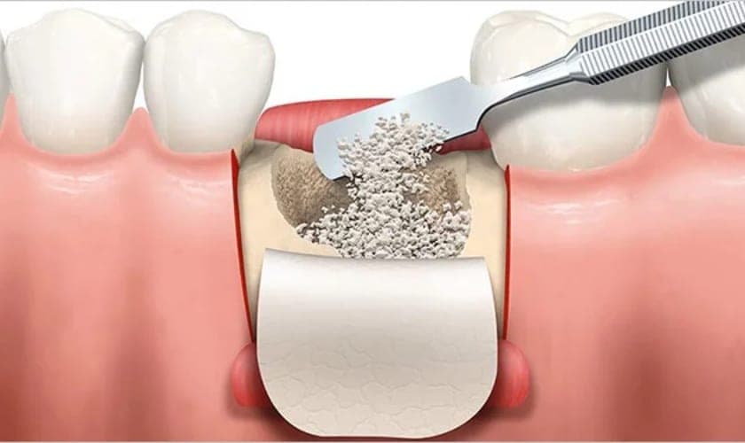 Bone Grafting